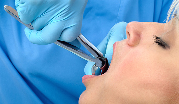 teeth-extraction